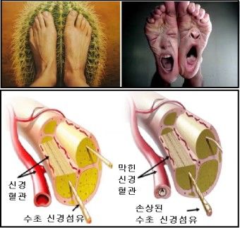 말초신경병증 증상