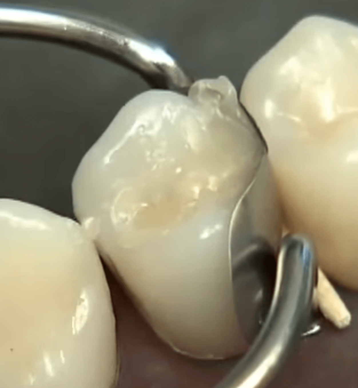 치아 치료 과정