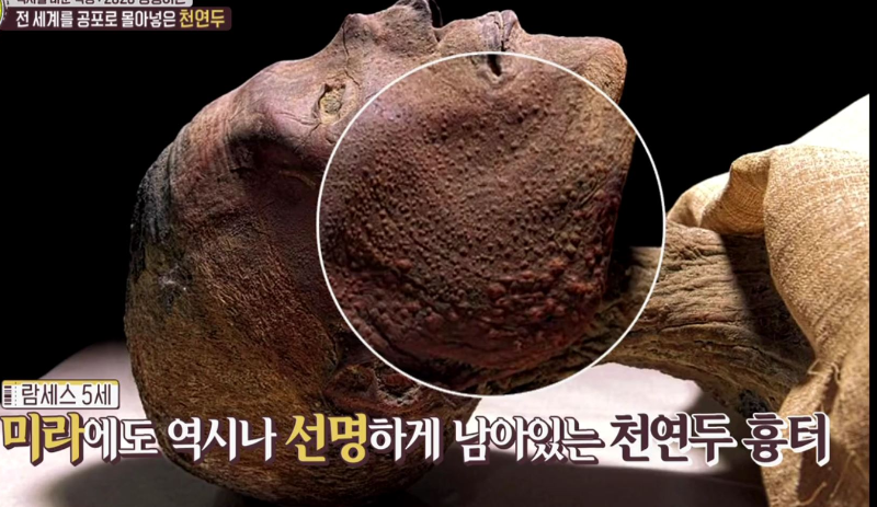 람세스 5세 미라에서 선명하게 남은 천연두 흉터