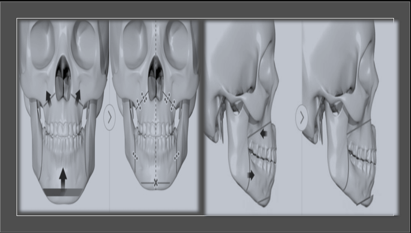미니양악수술의 부상과 인기 요인