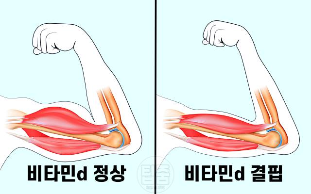 비타민d 결핍 증상 비타민d권장량