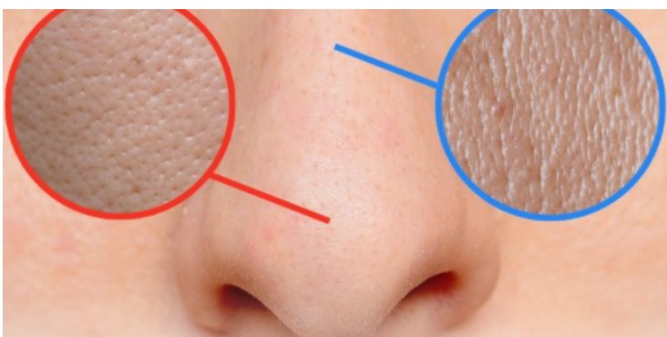 늘어난 모공 사진