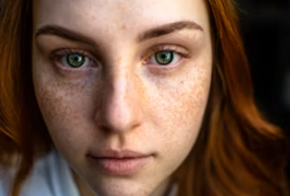 염증성 여드름의 원인