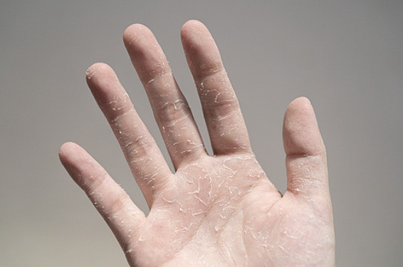 주부 습진 원인과 생활 속 예방법