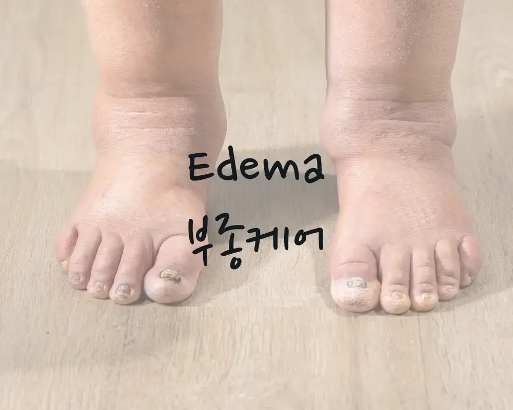 부종 붓기빼기 부종 원인 예방법