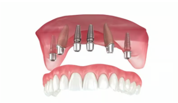 전체 임플란트 비용
