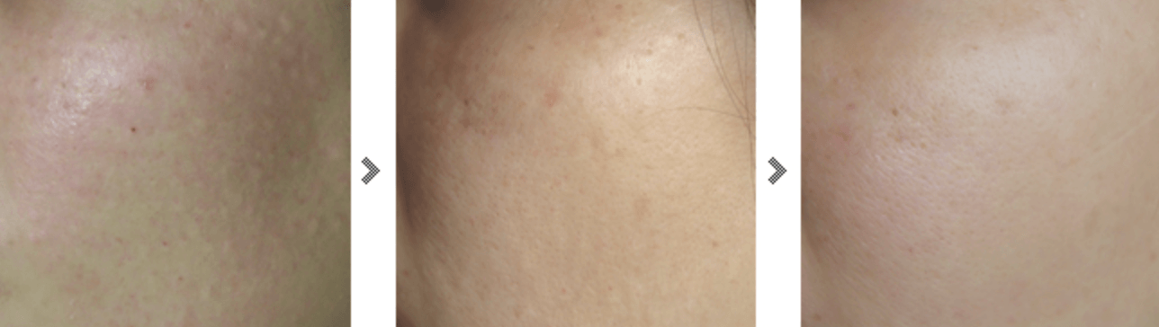 물광주사 유지기간