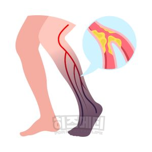 혈색소 수치가 높으면