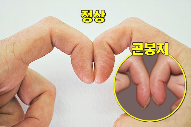 손가락 곤봉지 폐암 증상 심장병, 심장이 안좋을때 증상, 손톱으로 보는 건강상태, 건강 팁줌 매일꿀정보