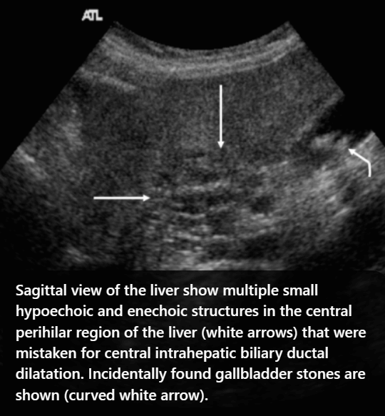 담관주변 낭종 (Peribiliary cyst)