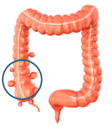 게실염의 예방법