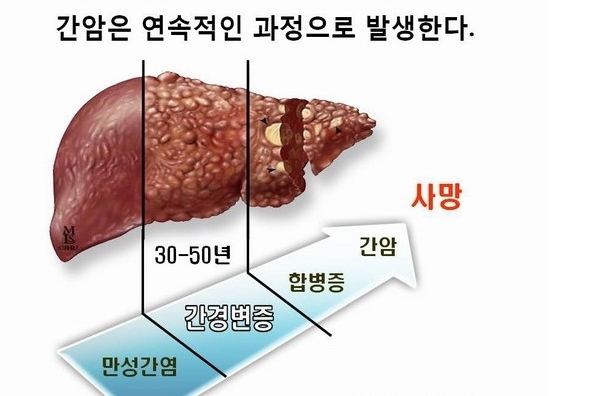 간경화 초기증상 치료법 간이 나쁘면 나타나는 증상 15가지