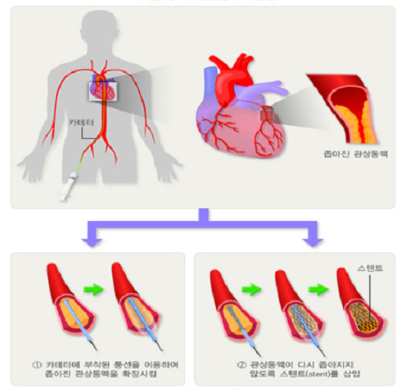 협심증 초기증상 1