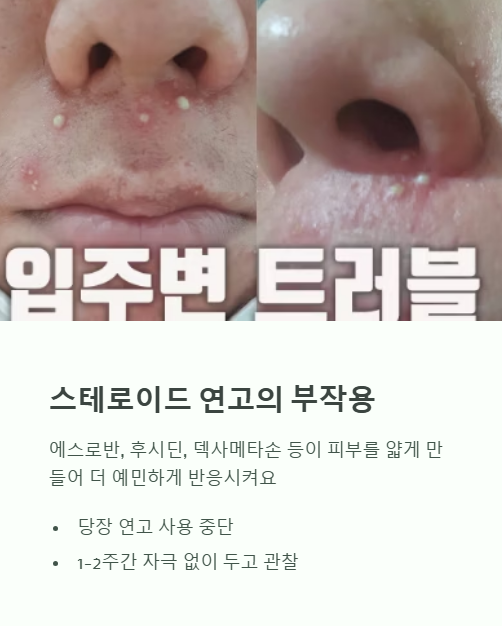 스테로이드 연고의 부작용