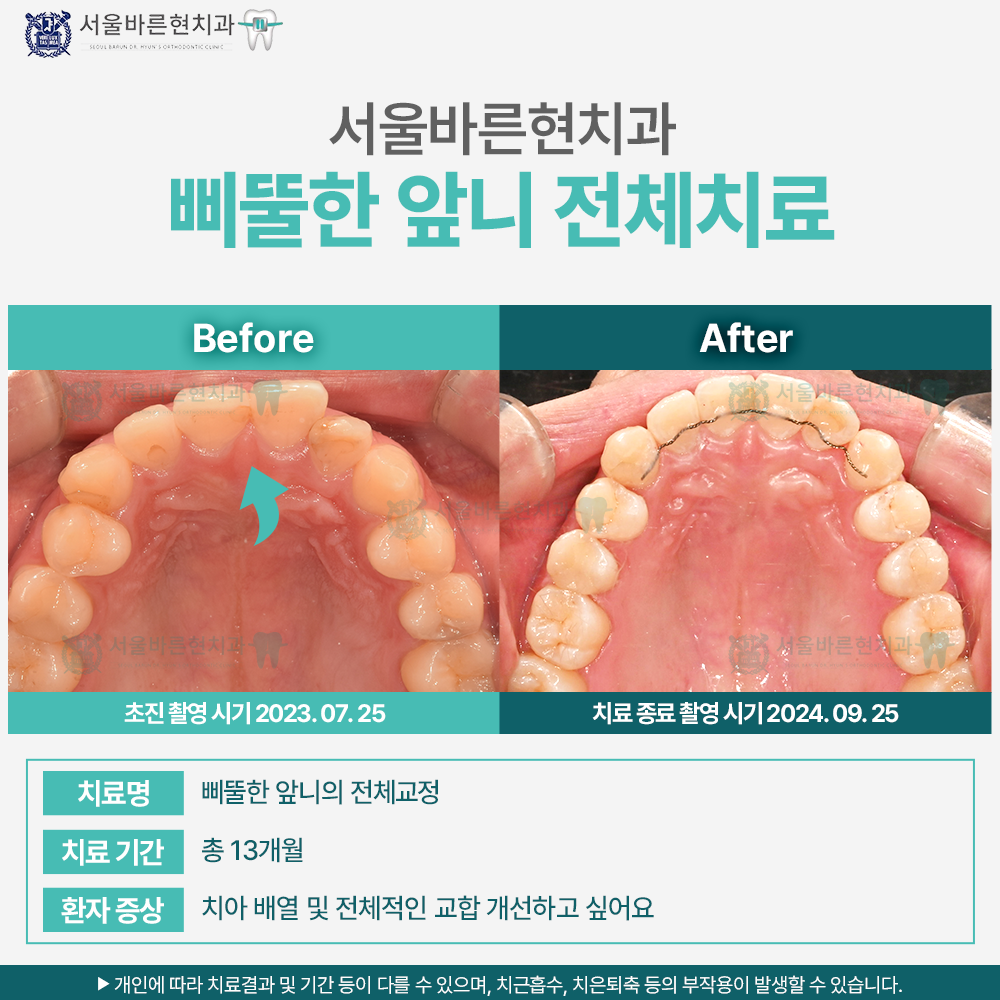 부산치아교정