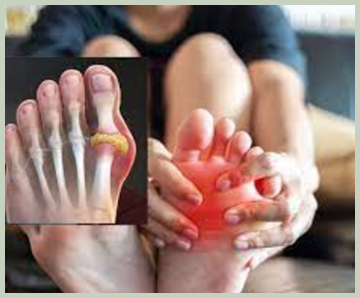 요산수치가 높을때 대처 방법