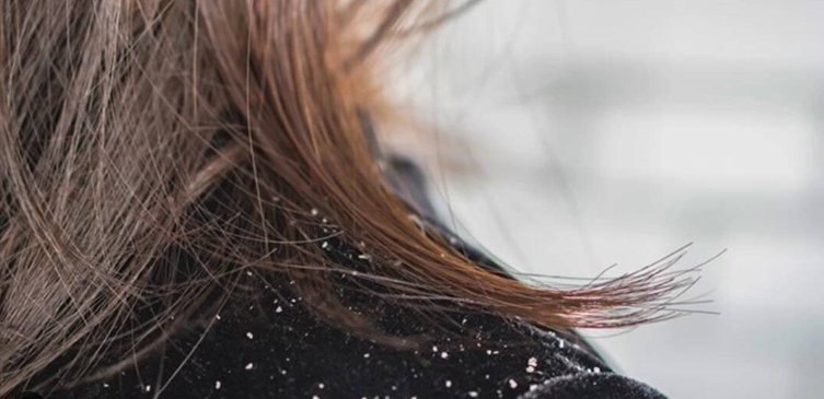 지루성피부염으로 인해 어깨에 비듬이 떨어짐