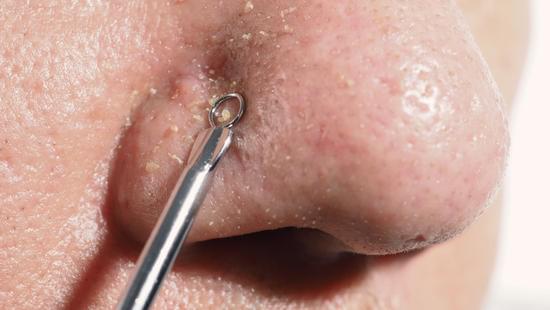 블랙헤드 짜는 법, 안전하게 하고 싶다면 꼭 알아야 할 것들