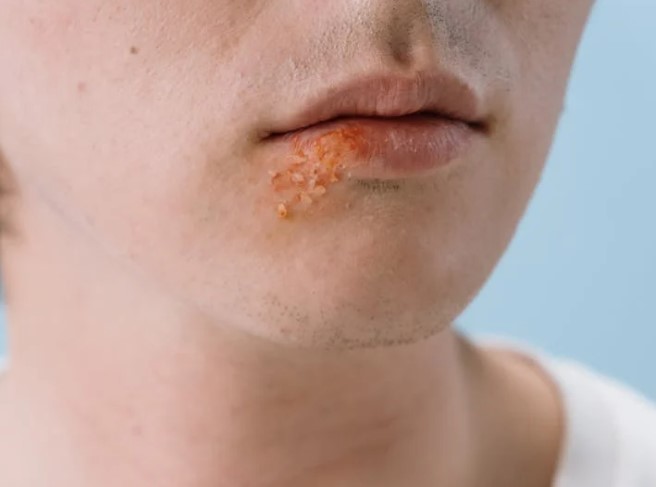 입술 헤르페스 감염 사진