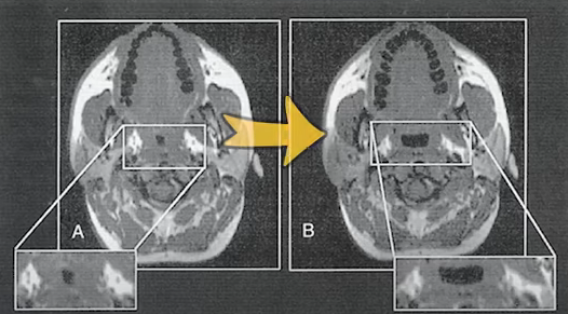 체중감량시 기도가 넓어지는 사진