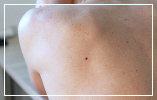 몸에-빨간점이-생기는-이유