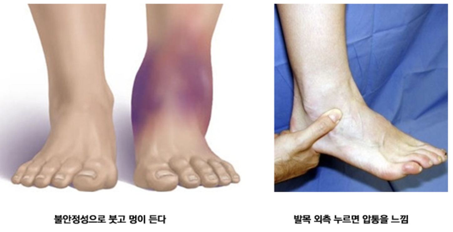 발목 외측인대파열 증상