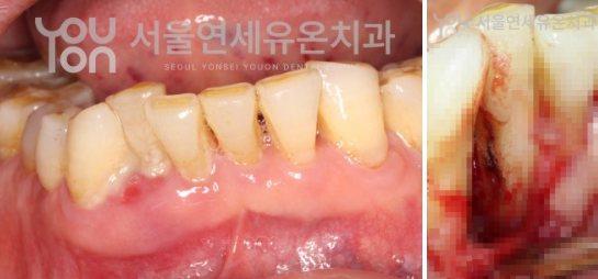 치아 뿌리 옆면의 오목한 부위에 달라붙은 치석 - 칫솔질로 닿을 수 없는 영역