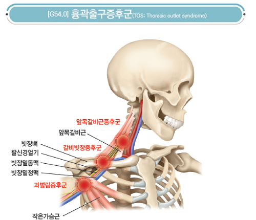 흉곽출구-증후군
이미지-출처:(http://chakom.org/bbs/board.php?bo_table=know&wr_id=146&sca=%EC%A0%84%EB%AC%B8%EA%B0%80%EC%BB%AC%EB%9F%BC&page=4)