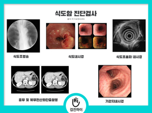 식도암