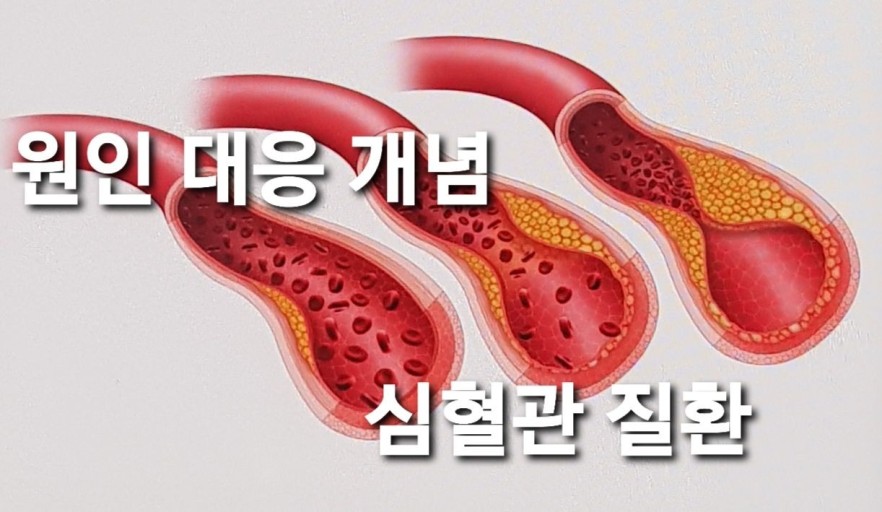 심혈관질환-대응법