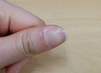 손톱이 갈라지는 이유 원인 증상 대처법_7