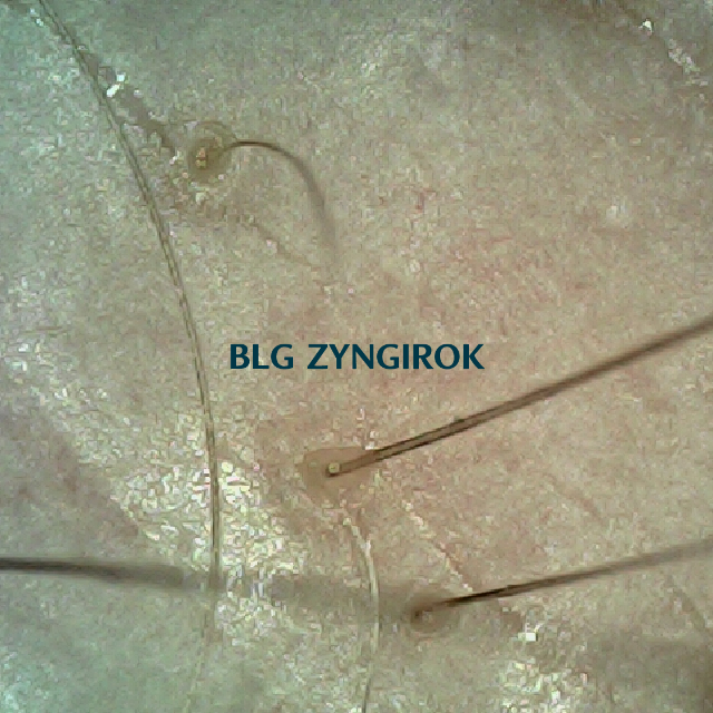 탈모 극복 프로젝트 - 70주차 오른쪽 M자 부위 두피 모습이다.