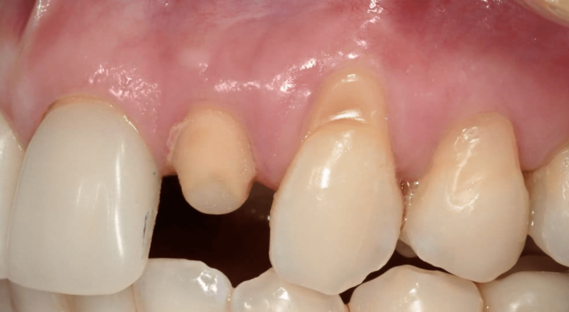 앞니 이빨 깨짐