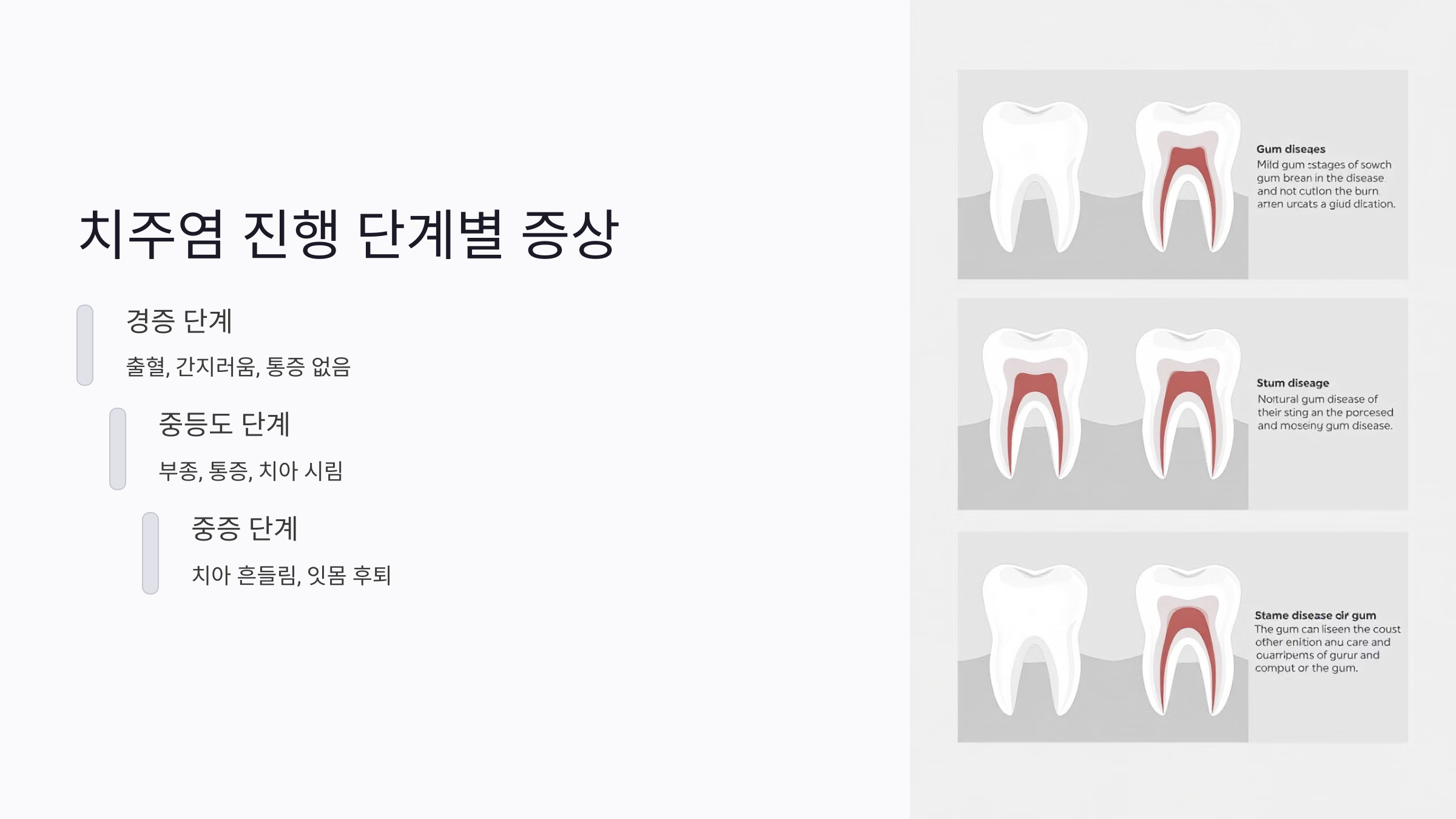 치주염 진행 단계별 증상과 치료 타이밍