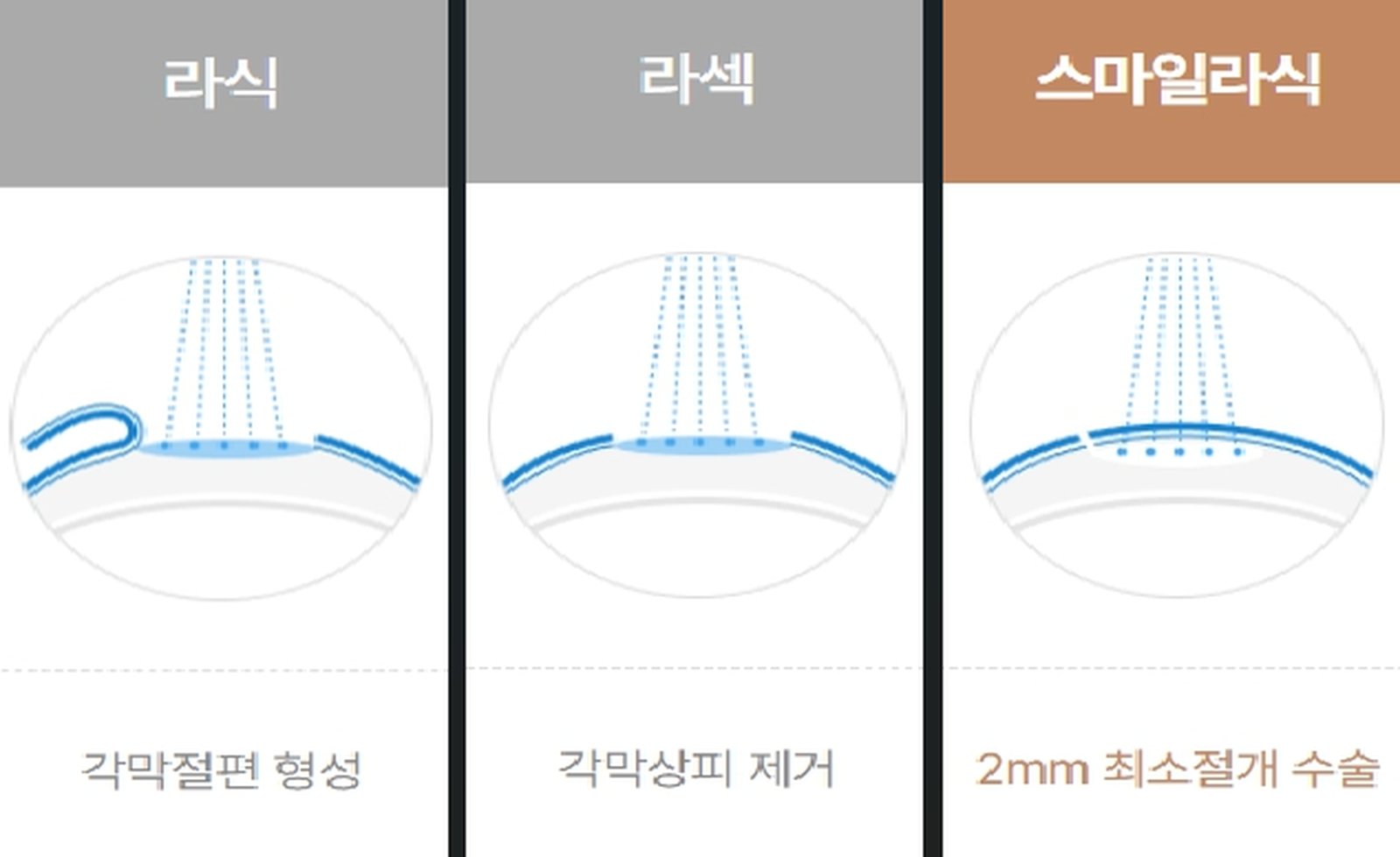 스마일라식 회복기간 가격 수술법 ❘ 부작용 주의점 ❘ 라섹 라식 비교