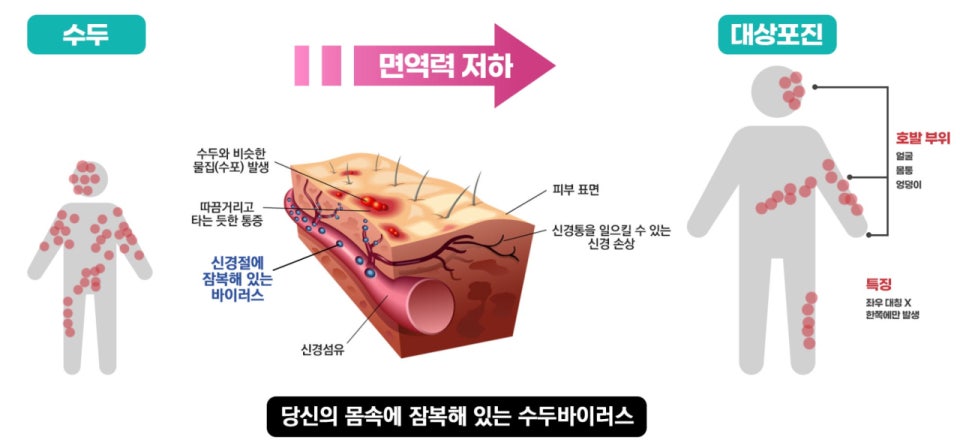 대상포진의 증상 및 원인