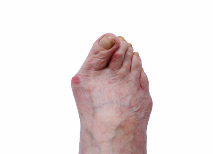 류마티스 관절염 말기