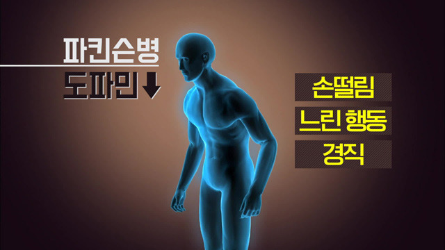 파킨슨병 관련 사진