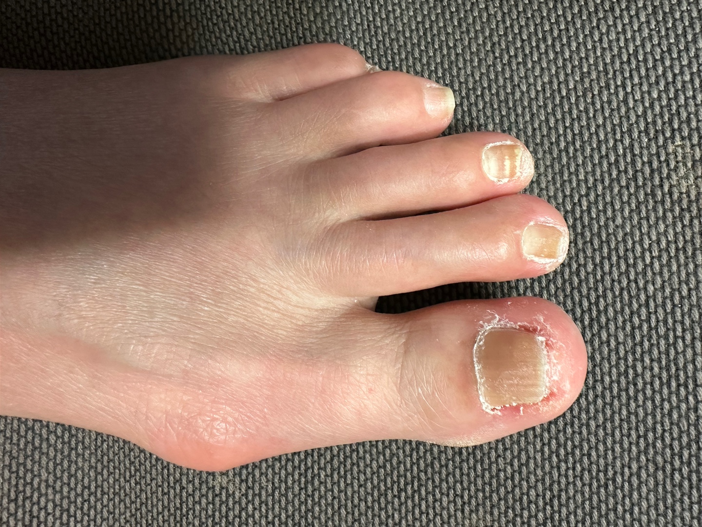 발톱 무좀 종류