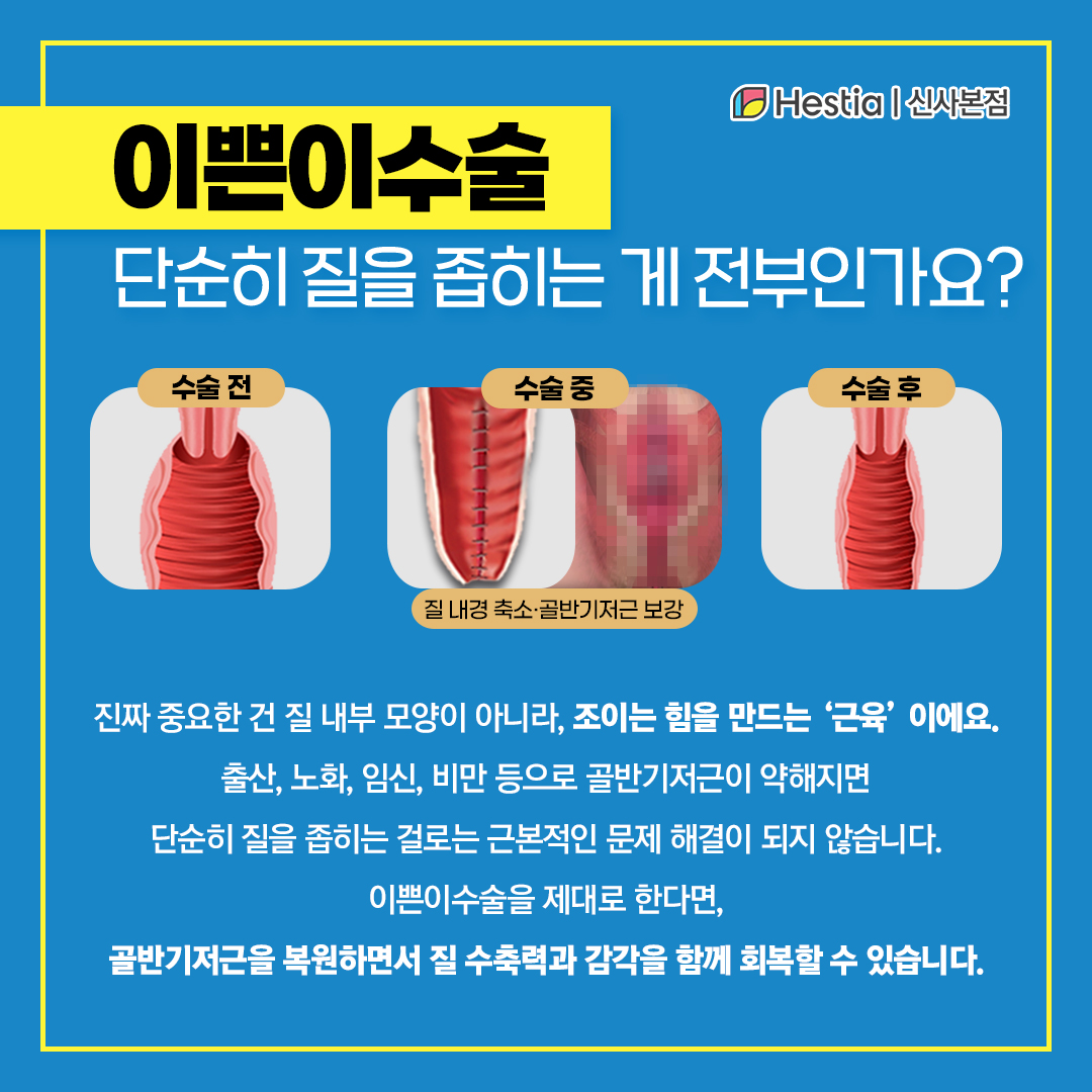 이쁜이수술 질을 좁히기만 하면 되나요?