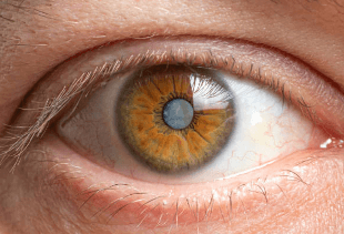 라식 라섹 노안