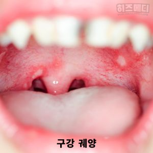 수족구 증상