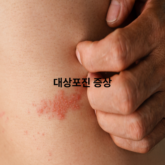 대상포진 신경통 증상과 완화법