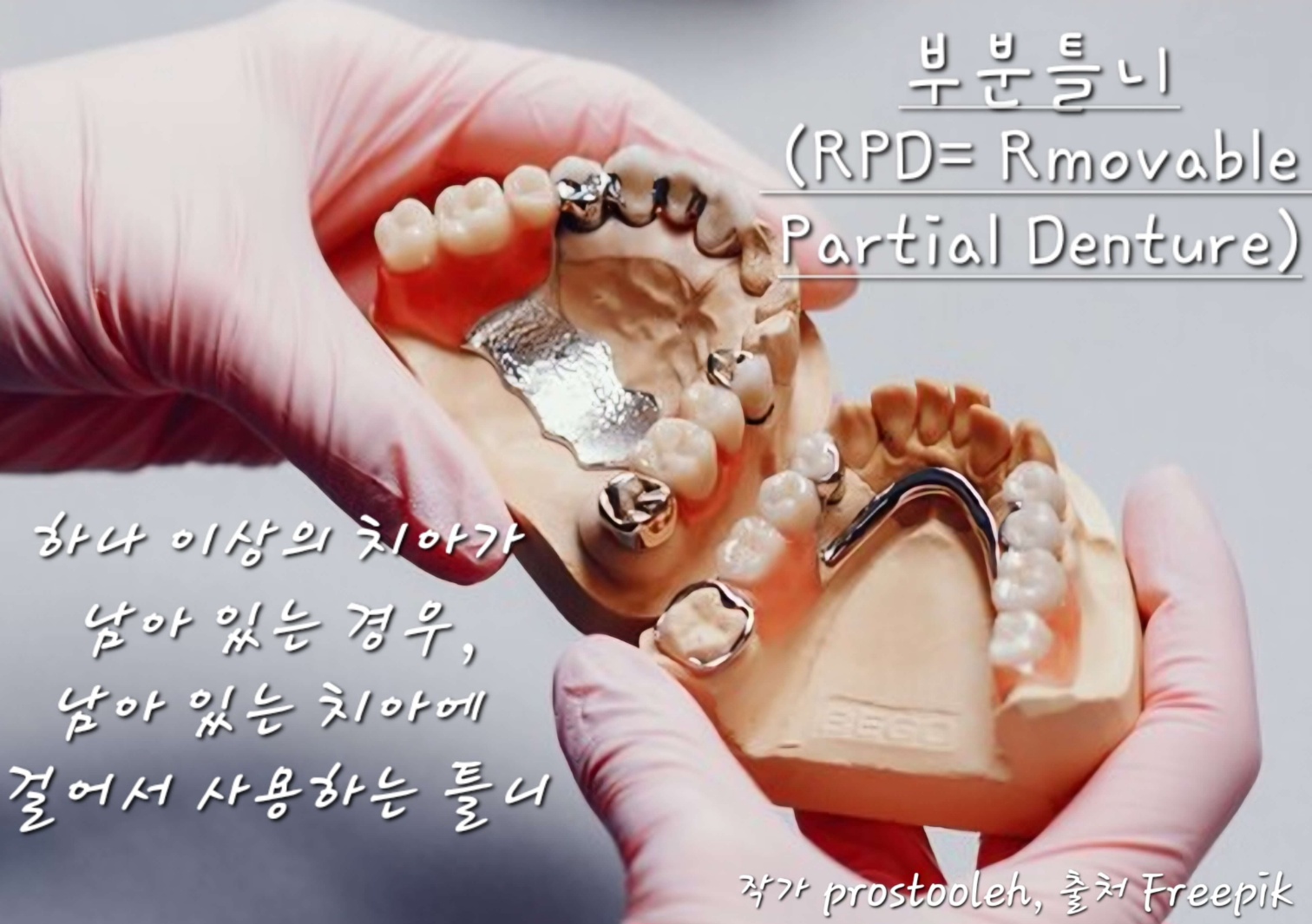 부분틀니사진