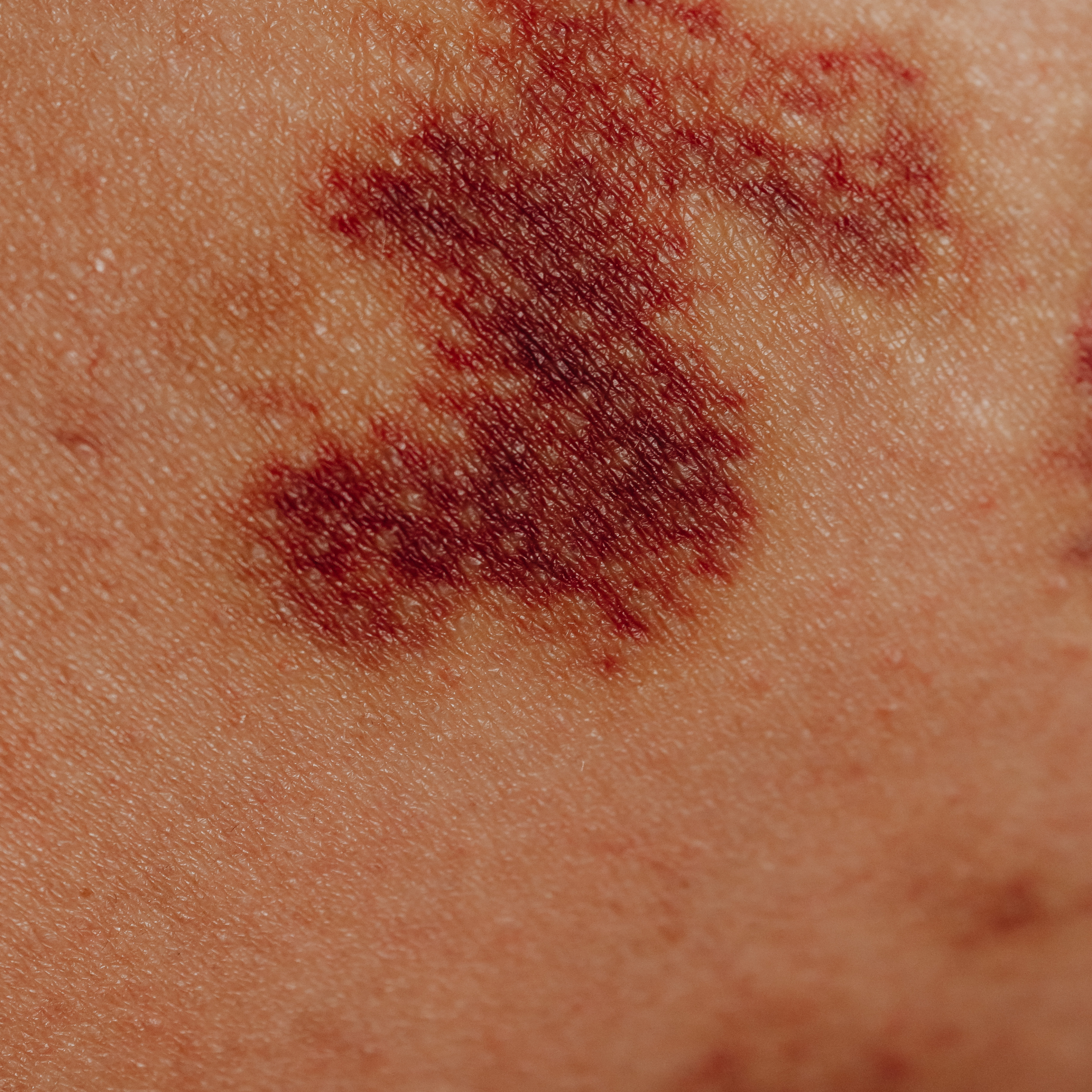 멍 빨리 빼는 과학적 방법