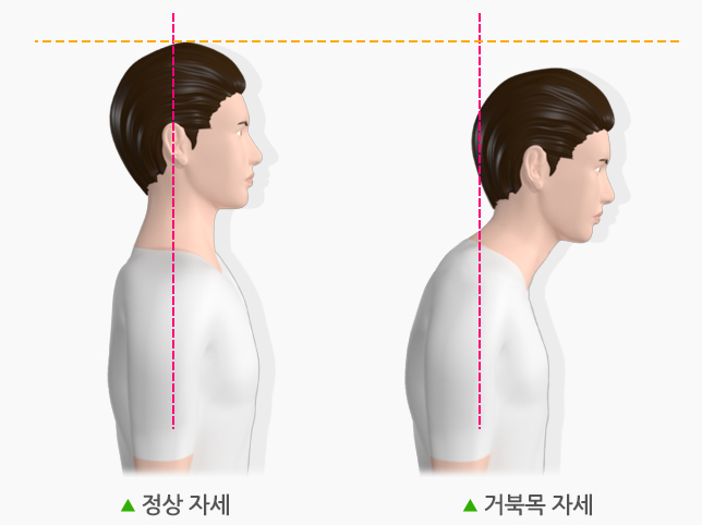 거북목