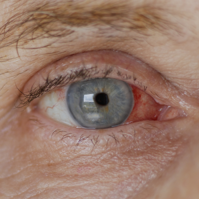 백내장 증상, 자가진단, 치료방법