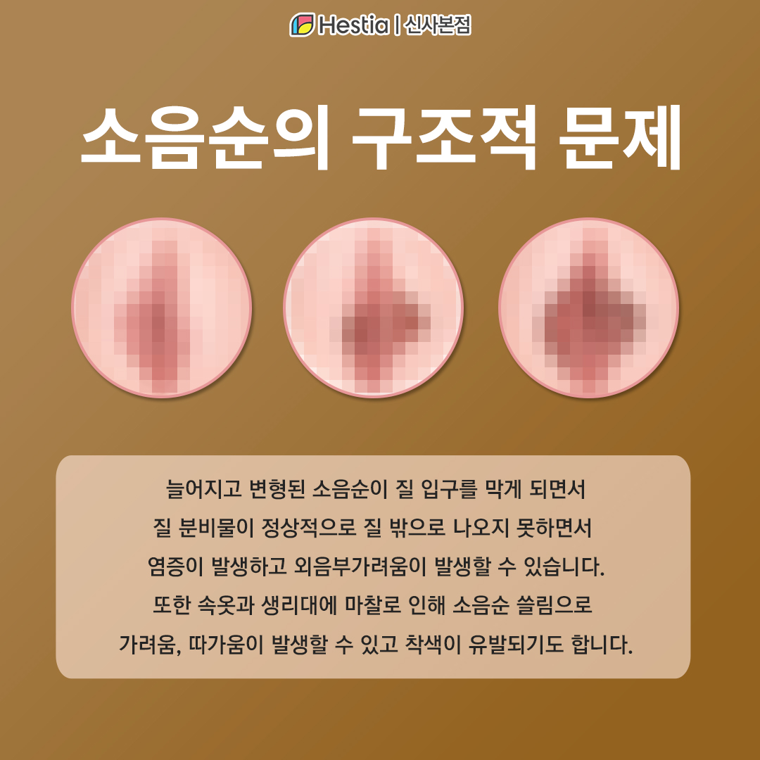 소음순성형수술의 효과