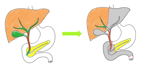 담도암 치료법: 수술&amp;#44; 항암&amp;#44; 면역요법