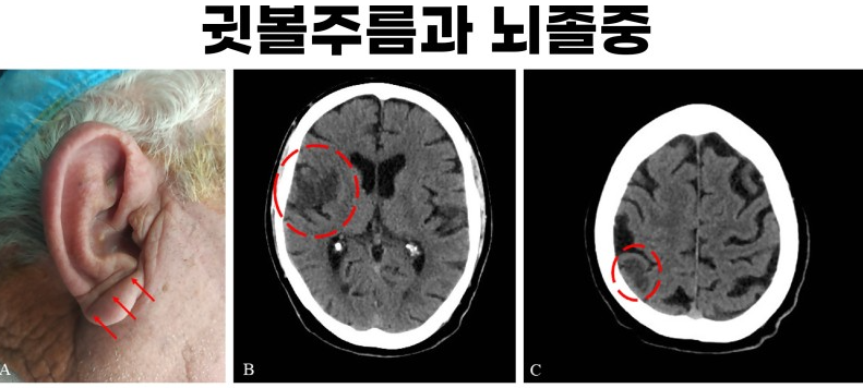 뇌졸중 전조증상 귀주름